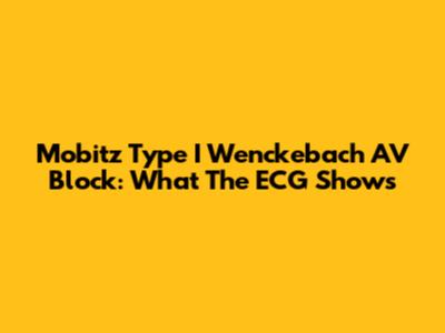Mobitz Type I Wenckebach AV Block: What The ECG Shows